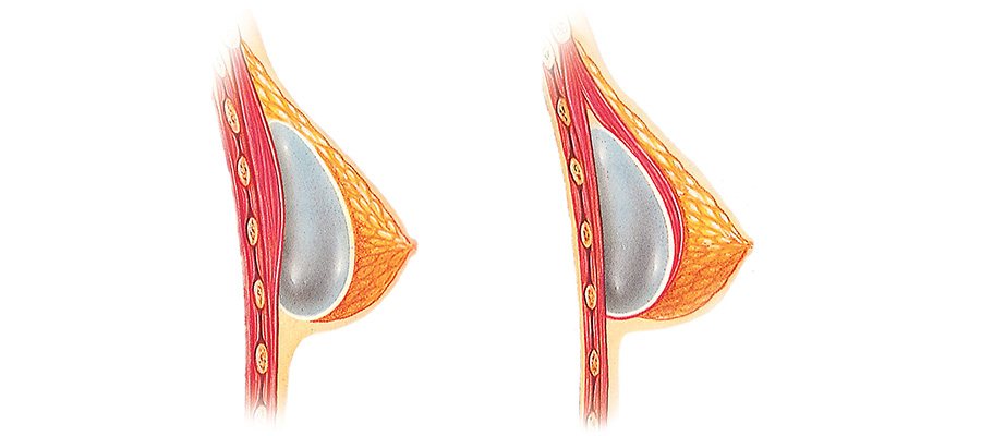 What Are The Differences for Breast Implant Placement?