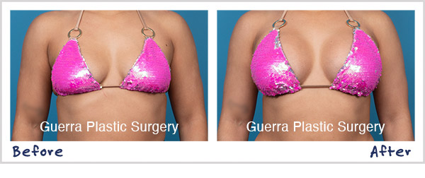 Breast Augmentation Before and After photo of actual patient