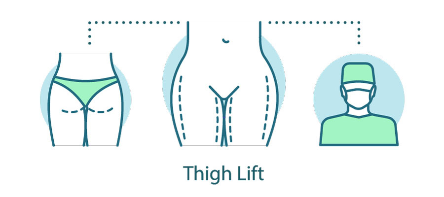 Diagram of thigh lift