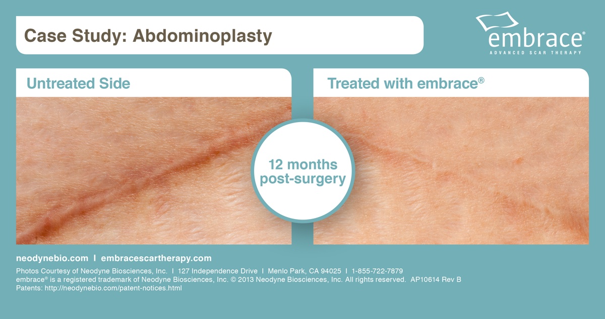 embrace before and after photo courtesy of Neodyne Biosciences