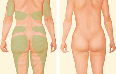 liposuction of back diagram