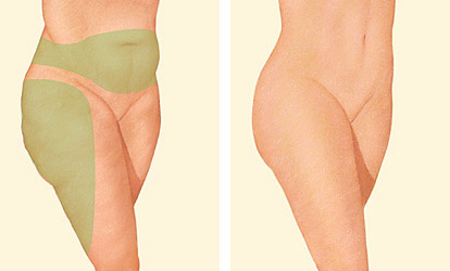 liposuction of thighs and tummy diagram