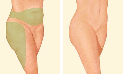liposuction of thighs and tummy diagram