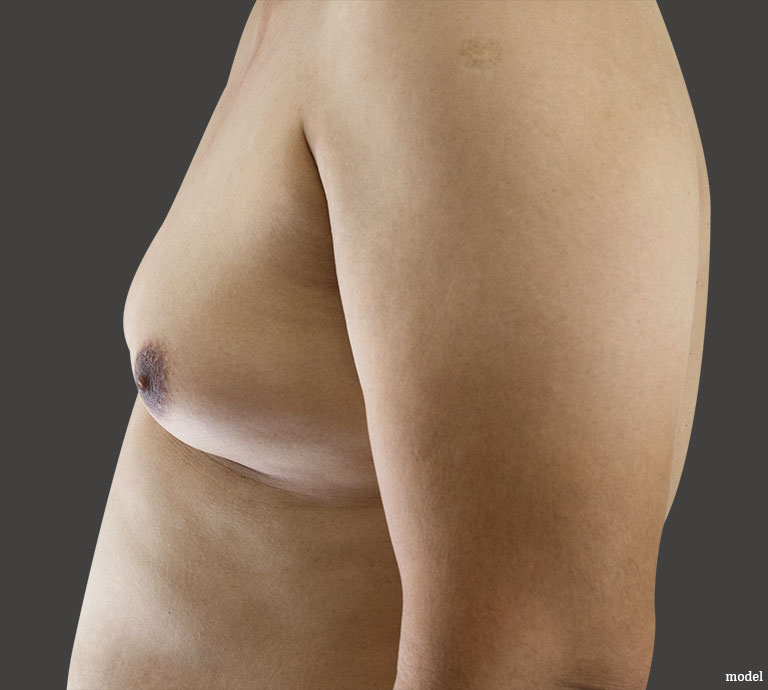 stock photo model for gynecomastia