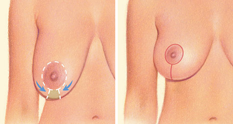 Vertical breast lift diagram