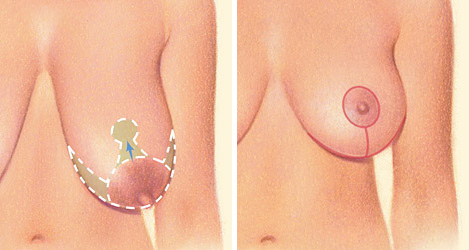 Wise Pattern breast lift diagram