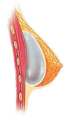 Above the muscle implant placement diagram