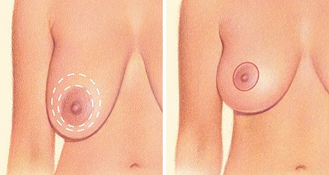 Periareolar breast lift diagram