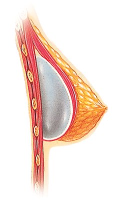 Under the muscle implant placement diagram