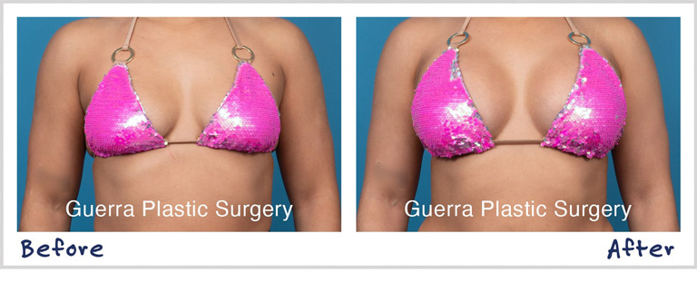 Actual patient photo - before and after Breast Augmentation