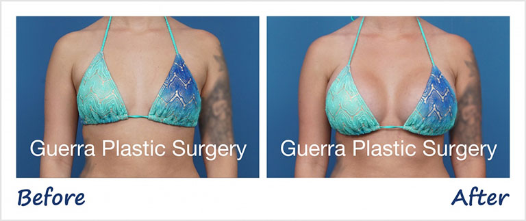 Actual patient photo - before and after Breast Augmentation