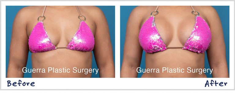 Actual patient photo - before and after Breast Augmentation