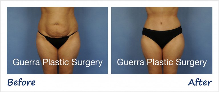 Actual patient photo - before and after Tummy Tuck